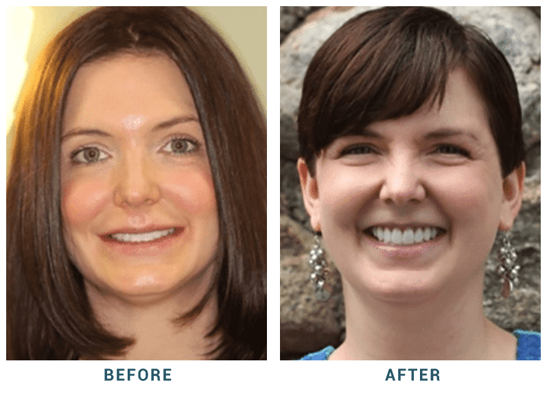 Before & After Results | Mohegan Lake & Tarrytown, New York