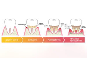 gum disease vector showing the stages of gum disease